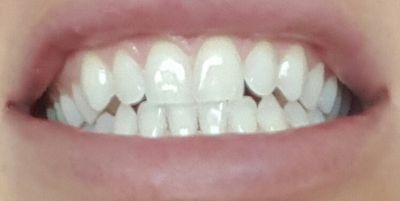 wybielanie zębów; wrażliwość; białe zęby; stomatologia; dentysta; zęby;