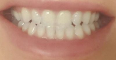 wybielanie zębów; wrażliwość; białe zęby; stomatologia; dentysta; zęby;